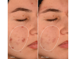 Dermalogica Breakout Biotic Moisturizer — гель-пробіотик для боротьби з акне, 50 мл