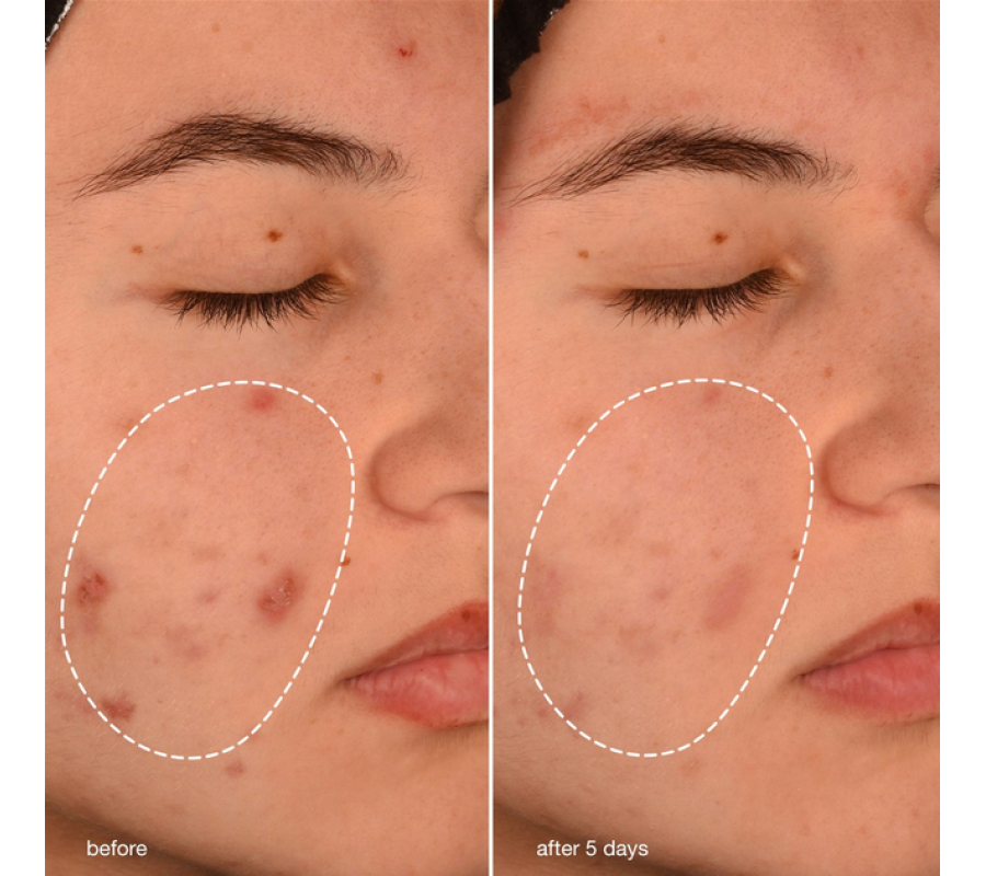 Dermalogica Breakout Biotic Moisturizer — гель-пробіотик для боротьби з акне, 50 мл