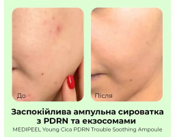 Young Cica PDRN Trouble Soothing Ampoule — ампульна сироватка для обличчя з центелою та полінуклеотидами, 50 мл