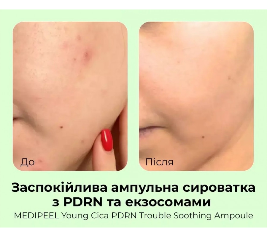 Young Cica PDRN Trouble Soothing Ampoule — ампульна сироватка для обличчя з центелою та полінуклеотидами, 50 мл