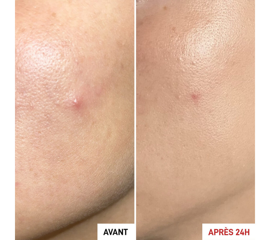 Локальний засіб для проблемної шкіри Centella SOS Patch Anti-Imperfections Erborian, 9 мл